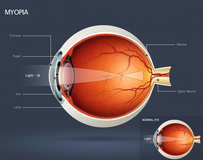 Diagram of Myopia, or Nearsightedness