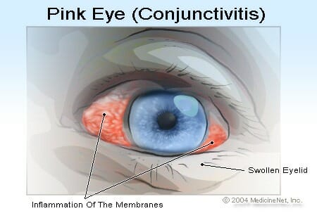 Conjunctivitis, or Pink Eye