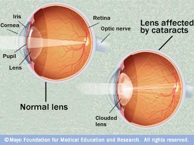 diagram of an eye cataract