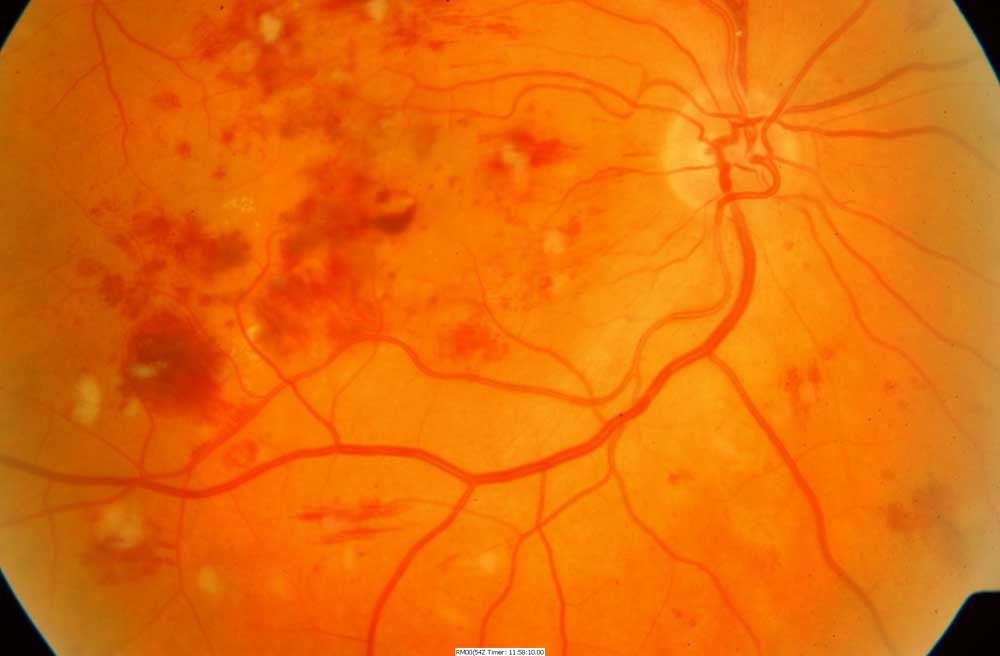macular edema picture