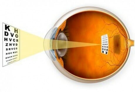 Myopia or Nearsightedness Diagram