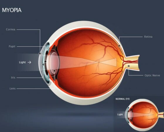 Understanding Myopia or Nearsightedness