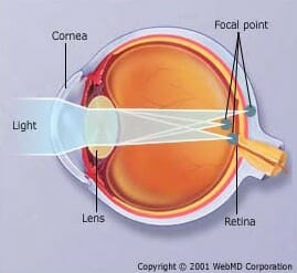 Understanding Astigmatism