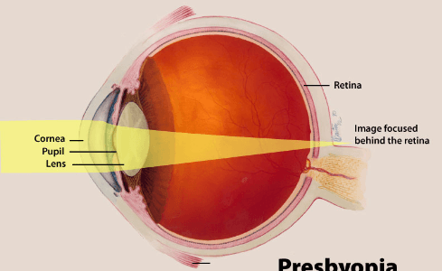 Understanding Presbyopia