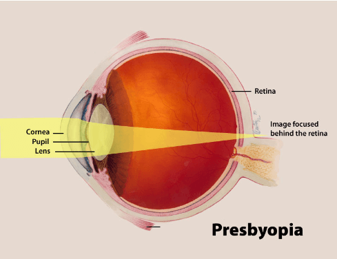 Understanding Presbyopia