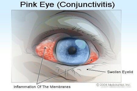 Understanding Conjunctivitis, or Pink Eye