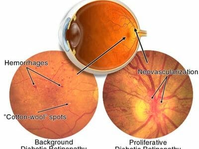 Understanding Diabetic Retinopathy