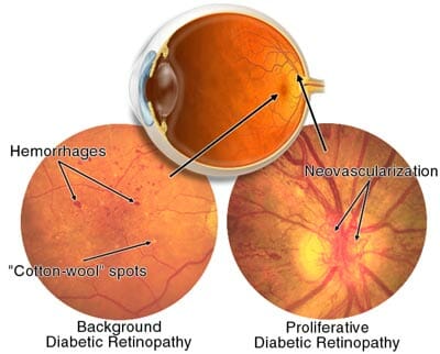 Understanding Diabetic Retinopathy