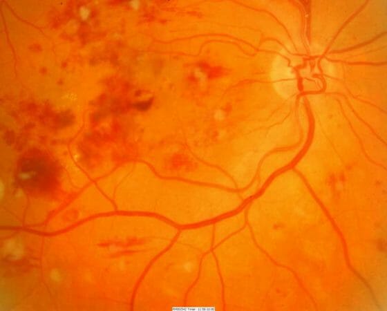 Causes and Types of Diabetic Retinopathy