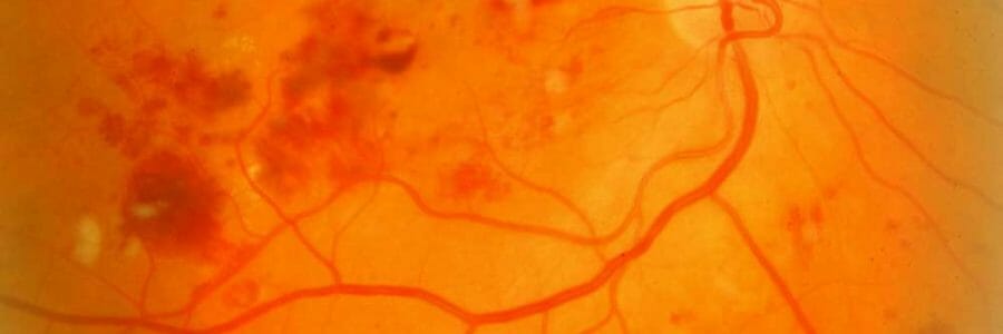 Causes and Types of Diabetic Retinopathy