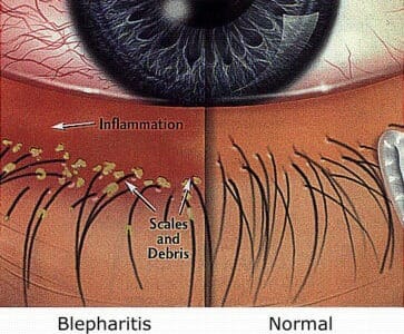 What Is Blepharitis and How to Treat It