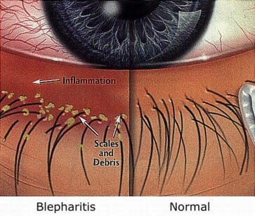 What Is Blepharitis and How to Treat It