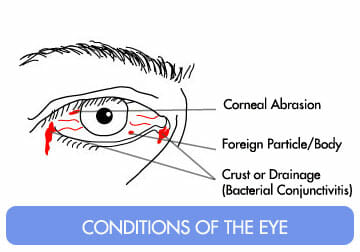 Six Common Diseases or Conditions Affecting the Eye