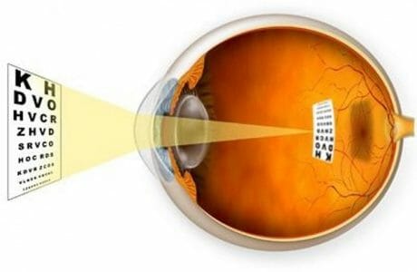 10 Things You Probably Didn’t Know About Myopia