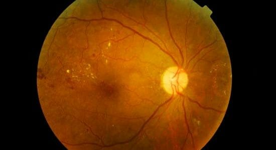 3 Common Eye Conditions Associated With Diabetes