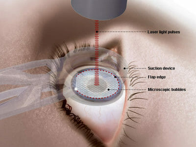 Introduction to LASIK Surgery